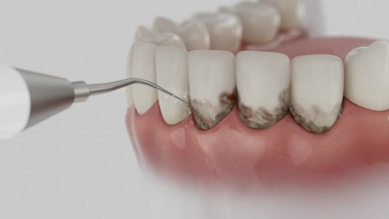 Trusted Wisdom Tooth Removal service in Kouts, IN - Dentist Open Now